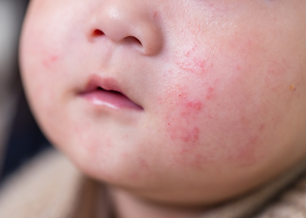 Eczema in Babies and Children