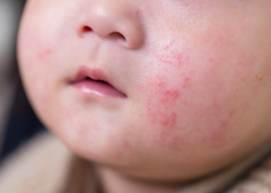 Eczema in Babies and Children